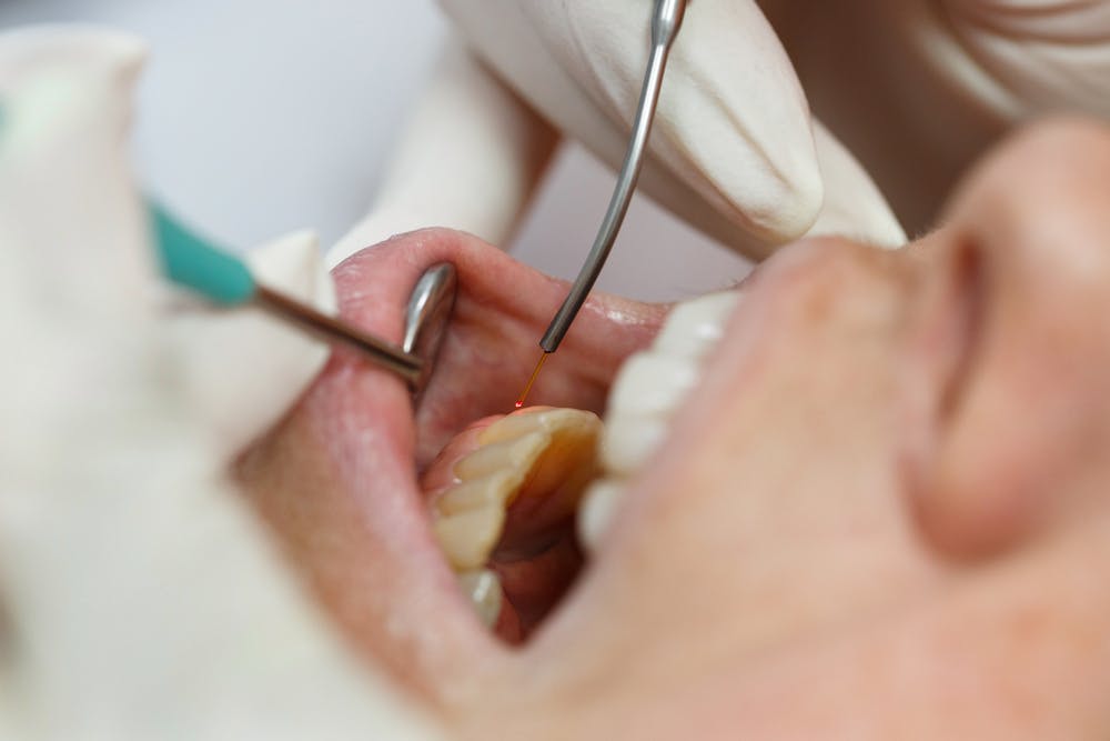 dental laser
